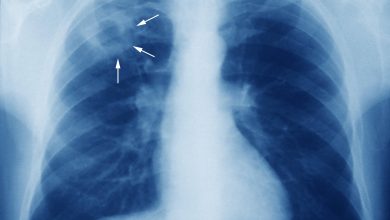 Tuberculosis