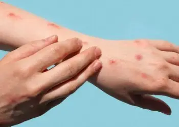 Mpox Outbreak: WHO confirms it's not new COVID-19