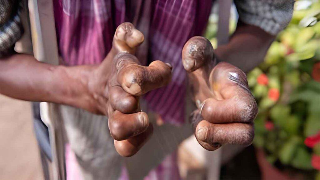 Succour for leprosy sufferers as WHO assures of drug supply