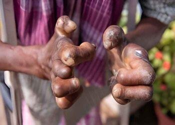 Succour for leprosy sufferers as WHO assures of drug supply
