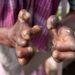 Succour for leprosy sufferers as WHO assures of drug supply