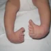 Clubfoot