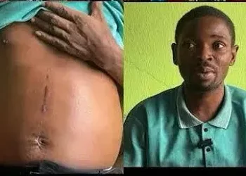 Ekiti dismisses surgeon over alleged kidney removal