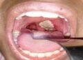 No Confirmed Case of Diphtheria in Enugu, State Govt Says