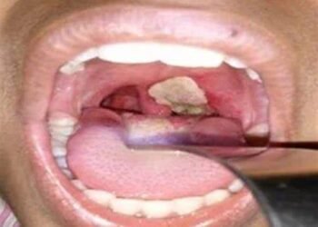 No Confirmed Case of Diphtheria in Enugu, State Govt Says