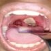 No Confirmed Case of Diphtheria in Enugu, State Govt Says