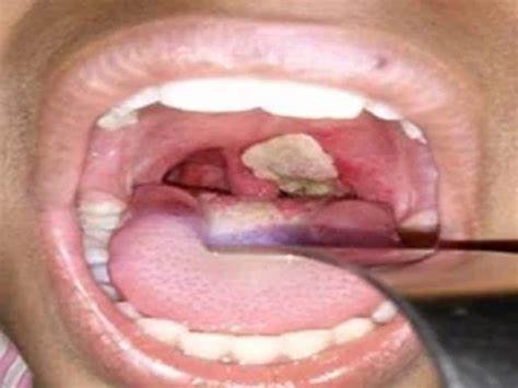No Confirmed Case of Diphtheria in Enugu, State Govt Says
