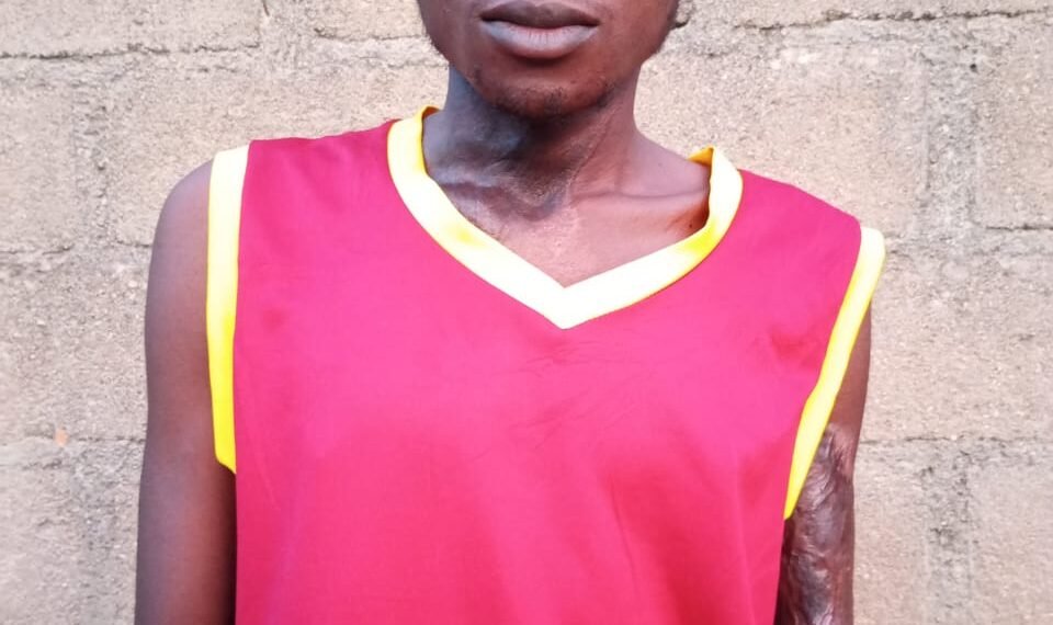 Taraba Polytechnic Student Who Lost Both Hands to Electrocution Loses One Eye, Seeks Urgent Help